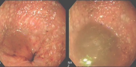 manejo_acalasia_avanzada/videoendoscopia_esfinter_inferior