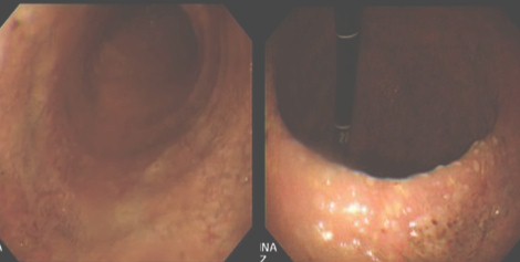 manejo_acalasia_avanzada/videoendoscopia_esofagitis_estasis