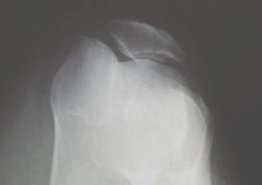 radiografia_axial_rotula/fractura_radiologica_rodilla