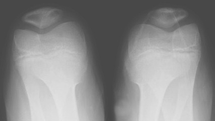 radiografia_axial_rotula/rx_articulacion_femoropatelar