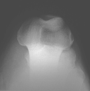 radiografia_axial_rotula/superposicion_condilos_femorales
