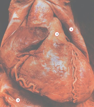 cancer_corazon_diafragma/capa_fibrosa_serosa