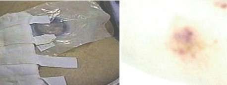 feohifomicosis_subcutanea_micoabsceso/colostomia_AP feohifomicosis_subcutanea_micoabsceso/colostomia_AP
