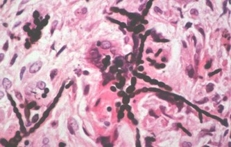 feohifomicosis_subcutanea_micoabsceso/histologia_anatomia_patologica feohifomicosis_subcutanea_micoabsceso/histologia_anatomia_patologica