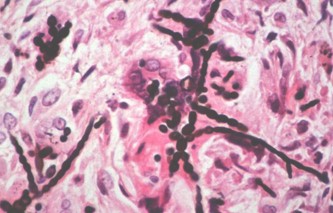 feohifomicosis_subcutanea_micoabsceso/histologia_anatomia_patologica