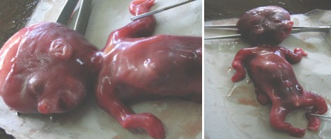 acondroplasia_caso_clinico/feto_acondroplasico acondroplasia_caso_clinico/feto_acondroplasico