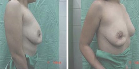 atencion_primaria_cirugia/anisomastia_asimetria_mamaria atencion_primaria_cirugia/anisomastia_asimetria_mamaria