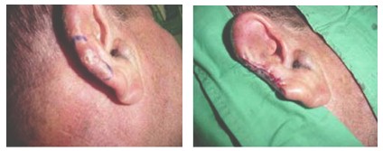 atencion_primaria_cirugia/carcinoma_basocelular_cirugia atencion_primaria_cirugia/carcinoma_basocelular_cirugia