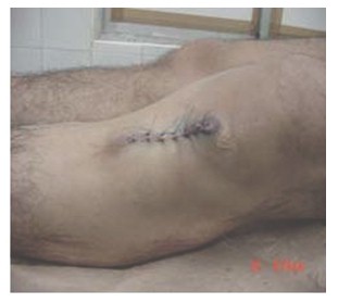 atencion_primaria_cirugia/hidrodenoma_nodular_postoperatorio atencion_primaria_cirugia/hidrodenoma_nodular_postoperatorio