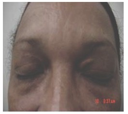 atencion_primaria_cirugia/xantelasma_parpado_cirugia atencion_primaria_cirugia/xantelasma_parpado_cirugia