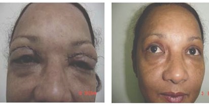 atencion_primaria_cirugia/xantelasma_parpado_operado atencion_primaria_cirugia/xantelasma_parpado_operado