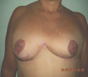 biparticion_mamaria_postmastectomia/mamoplastia_resultado_definitivo biparticion_mamaria_postmastectomia/mamoplastia_resultado_definitivo