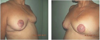 biparticion_mamaria_postmastectomia/tatuaje_pezon_mamoplastia biparticion_mamaria_postmastectomia/tatuaje_pezon_mamoplastia
