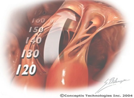 crisis_hipertensivas_HTA/hipertension_arterial crisis_hipertensivas_HTA/hipertension_arterial