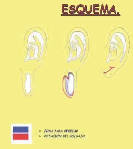 dilatacion_lobulo_oreja/planteamiento_cirugia_piercing dilatacion_lobulo_oreja/planteamiento_cirugia_piercing