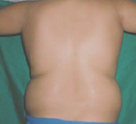 liposuccion_adolescentes_obesidad/gordura_infantil_IMC