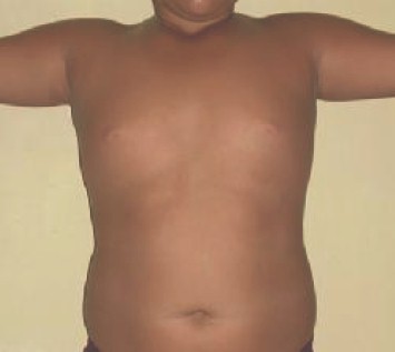 liposuccion_adolescentes_obesidad/resultados_resultado_cirugia