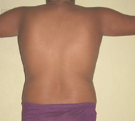 liposuccion_adolescentes_obesidad/resultados_resultado_quirurgico liposuccion_adolescentes_obesidad/resultados_resultado_quirurgico