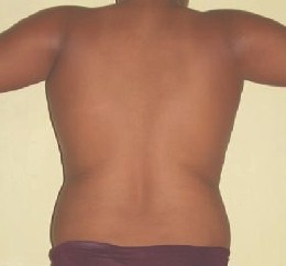 liposuccion_adolescentes_obesidad/resultados_resultado_quirurgicos