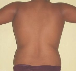 liposuccion_adolescentes_obesidad/resultados_resultado_quirurgicos liposuccion_adolescentes_obesidad/resultados_resultado_quirurgicos