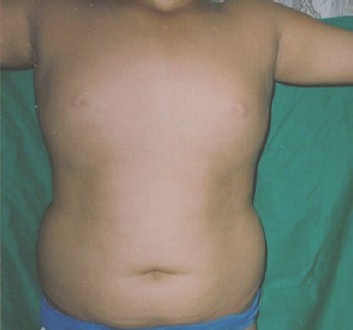 liposuccion_adolescentes_obesidad/sobrepeso_infantil_cirugia