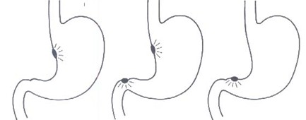 morbilidad_consulta_endoscopia/localizacion_topografica_ulcera morbilidad_consulta_endoscopia/localizacion_topografica_ulcera