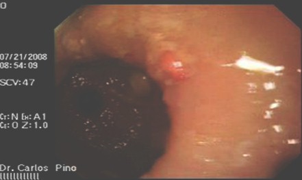 polipo_gastrico_endoscopia/antral_curvadura_mayor polipo_gastrico_endoscopia/antral_curvadura_mayor