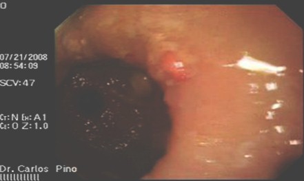 polipo_gastrico_endoscopia/antral_curvadura_mayor