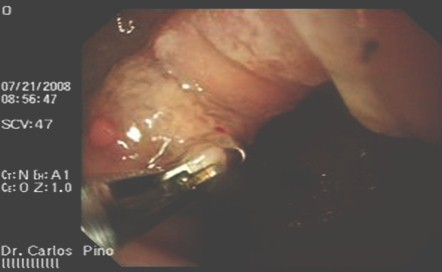 polipo_gastrico_endoscopia/antral_curvadura_menor