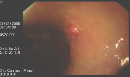 polipo_gastrico_endoscopia/antral_curvatura_mayor