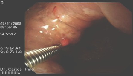polipo_gastrico_endoscopia/biopsia_lesiones_gastricas
