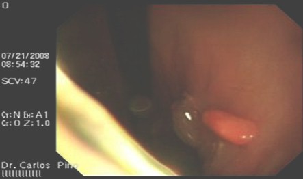 polipo_gastrico_endoscopia/cuerpo_gastrico_polipo polipo_gastrico_endoscopia/cuerpo_gastrico_polipo