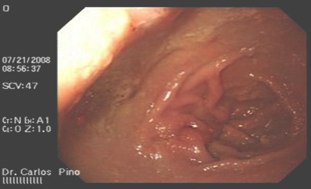 polipo_gastrico_endoscopia/eritema_prepiloro_antro