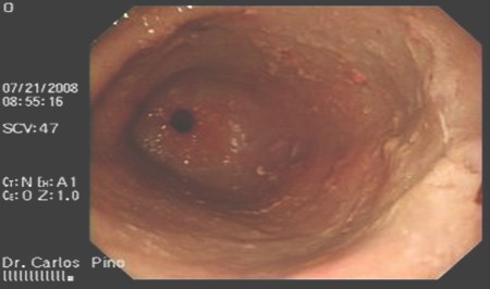 polipo_gastrico_endoscopia/eritema_region_prepilorica polipo_gastrico_endoscopia/eritema_region_prepilorica
