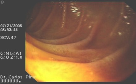 polipo_gastrico_endoscopia/mucosa_duodenal_blanquecina