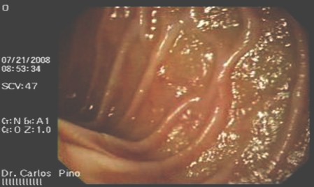 polipo_gastrico_endoscopia/mucosa_duodenal_gastroduodenal