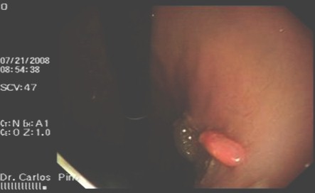 polipo_gastrico_endoscopia/polipos_cuerpo_gastrico polipo_gastrico_endoscopia/polipos_cuerpo_gastrico