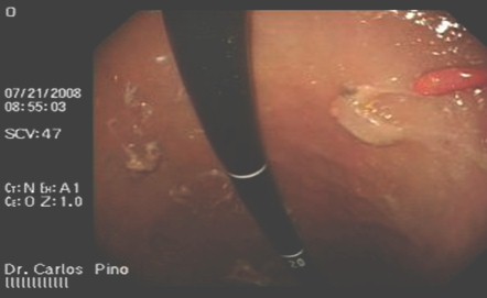 polipo_gastrico_endoscopia/poliposis_cuerpo_gastrico polipo_gastrico_endoscopia/poliposis_cuerpo_gastrico
