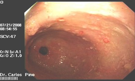 polipo_gastrico_endoscopia/poliposis_region_antral