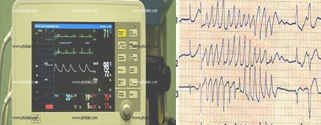 resucitacion_cardiopulmonar_avanzada/taquicardia_ventricular_TV