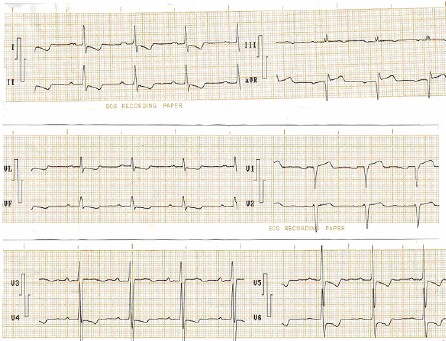 ECG_IAM_IMA/IAM_sin_Q ECG_IAM_IMA/IAM_sin_Q