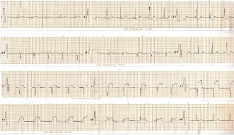 ECG_IAM_IMA/infarto_cara_anterior