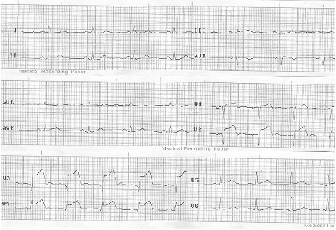 ECG_IAM_IMA/supradesnivel_ST_infarto