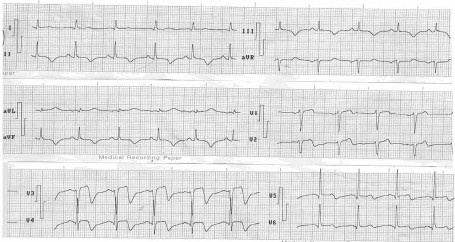 ECG_IAM_IMA/supradesnivel_infarto_anteroseptal