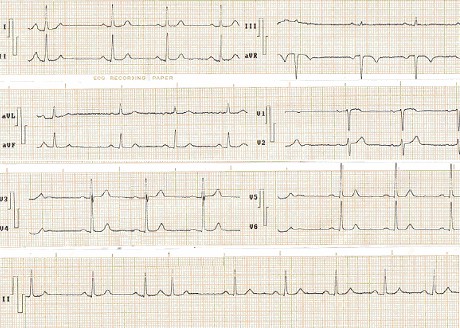 ECG_arritmias_supraventriculares/arritmia_sinusal_respiratoria