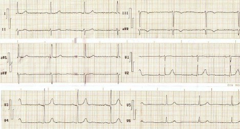 ECG_arritmias_supraventriculares/bradicardia_sinusal.