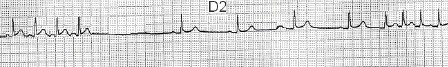 ECG_arritmias_supraventriculares/disfuncion_sinoauricular