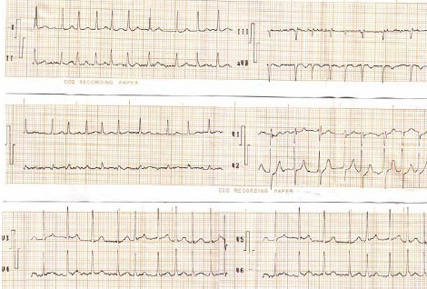 ECG_arritmias_supraventriculares/fibrilacion_auricular_rapida ECG_arritmias_supraventriculares/fibrilacion_auricular_rapida