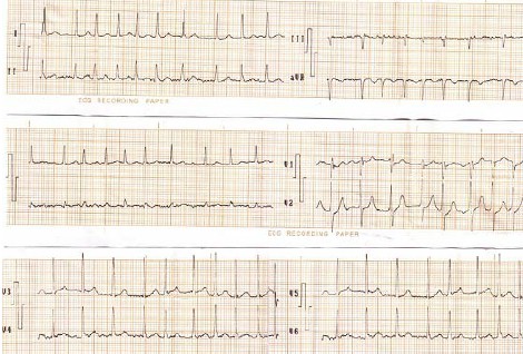 ECG_arritmias_supraventriculares/fibrilacion_auricular_rapida