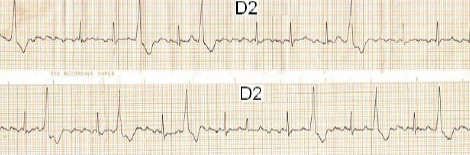 ECG_arritmias_supraventriculares/flutter_auricular. ECG_arritmias_supraventriculares/flutter_auricular.